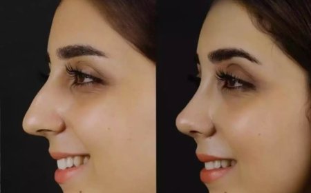 From Diagnosis to Relief: Journey with the Best Septoplasty Surgeon in Dubai