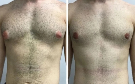 Choosing Between the Best Gynecomastia Surgeons in Dubai: What Matters Most?