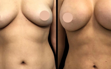 Is Breast Augmentation in Dubai Right for You?
