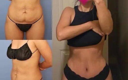 Tummy Tuck in Dubai: Expert Doctors Who Deliver Amazing Results