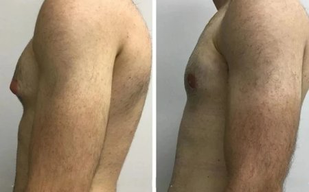 Real Patient Stories of Overcoming Gynecomastia in Dubai