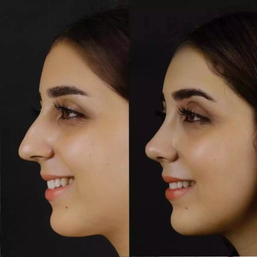 From Diagnosis to Relief: Journey with the Best Septoplasty Surgeon in Dubai