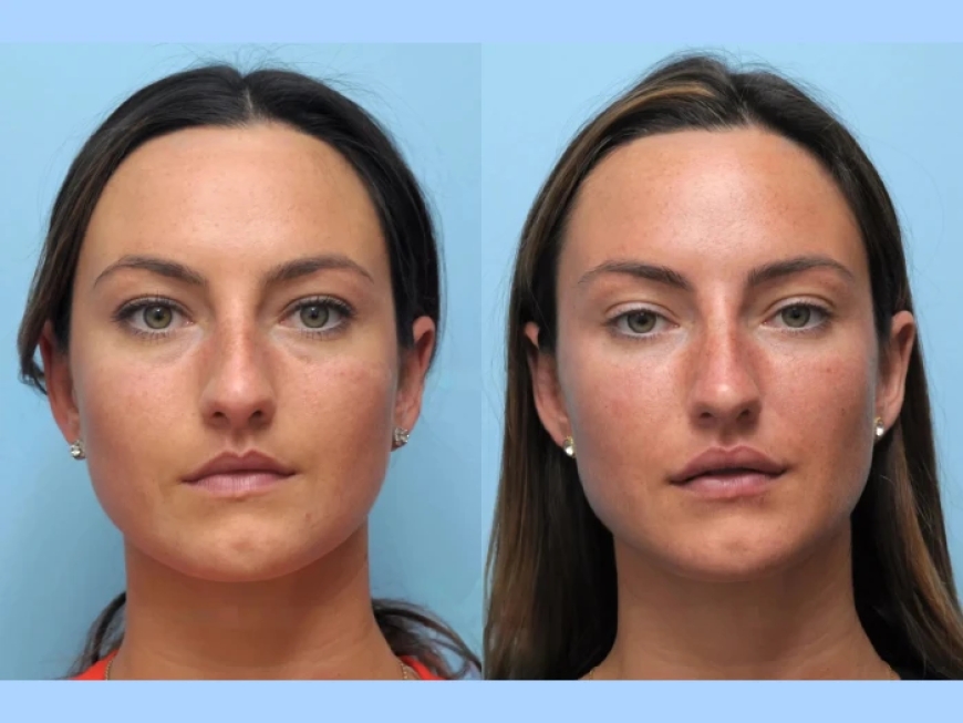 Discover the Benefits of Thread Lift Treatment in Dubai