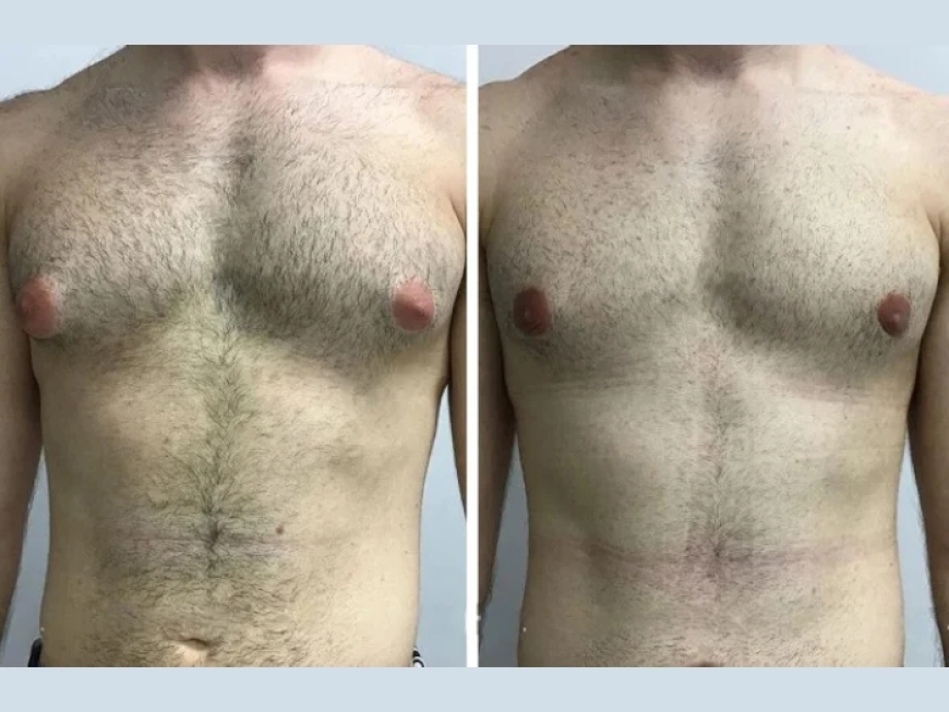 Choosing Between the Best Gynecomastia Surgeons in Dubai: What Matters Most?
