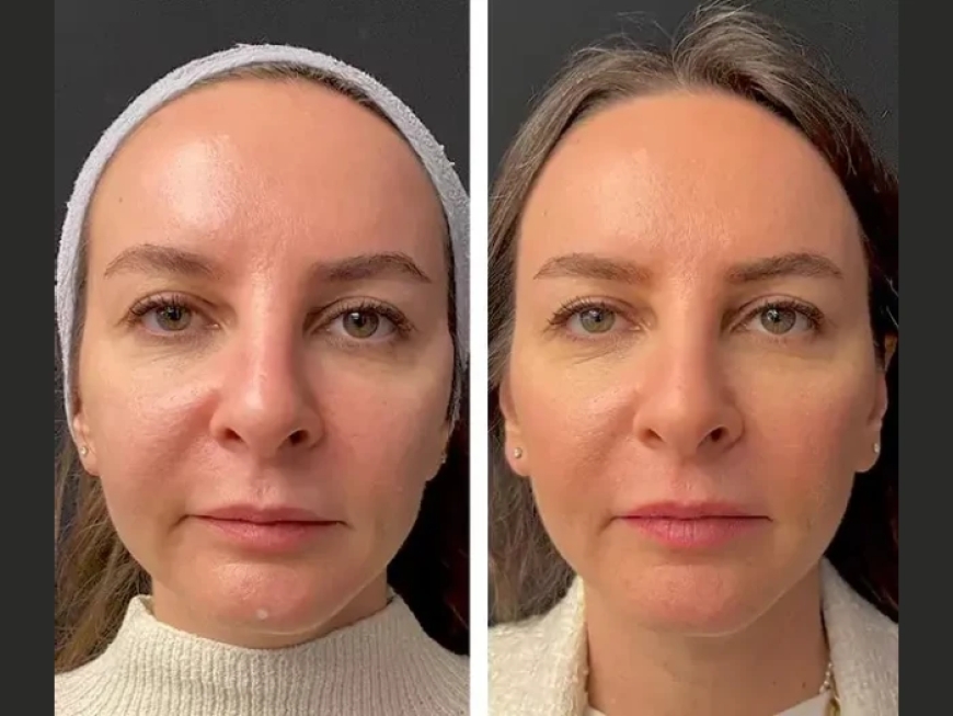 Expert Tips from the Best Doctors in Dubai on Post-Mesotherapy Care