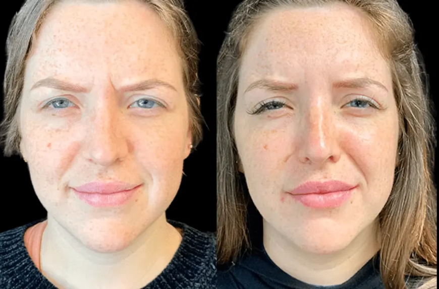 The Latest Botox Techniques Used by the Best Doctors in Dubai