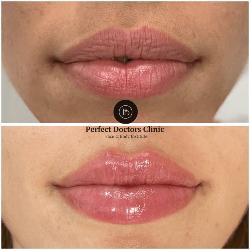 Dermal Fillers for Forehead Lines: What You Should Know from the Best Doctors in Dubai