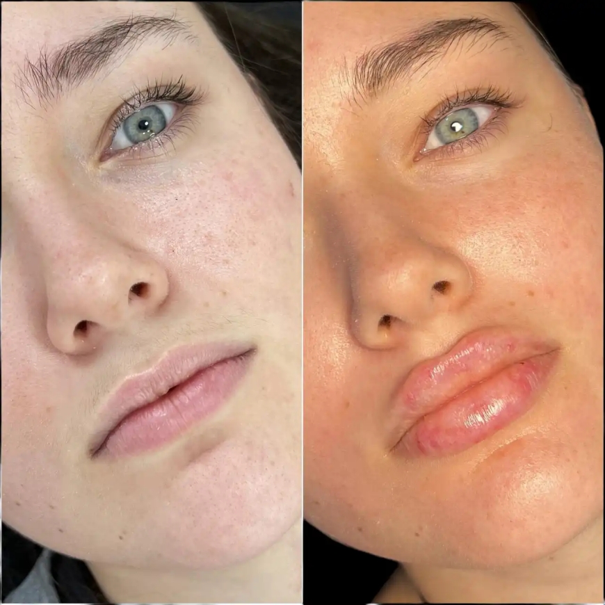 Inside Dubai’s Aesthetic Scene with the Best Doctors in Dubai for Fillers