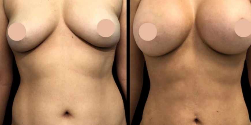 Is Breast Augmentation in Dubai Right for You?
