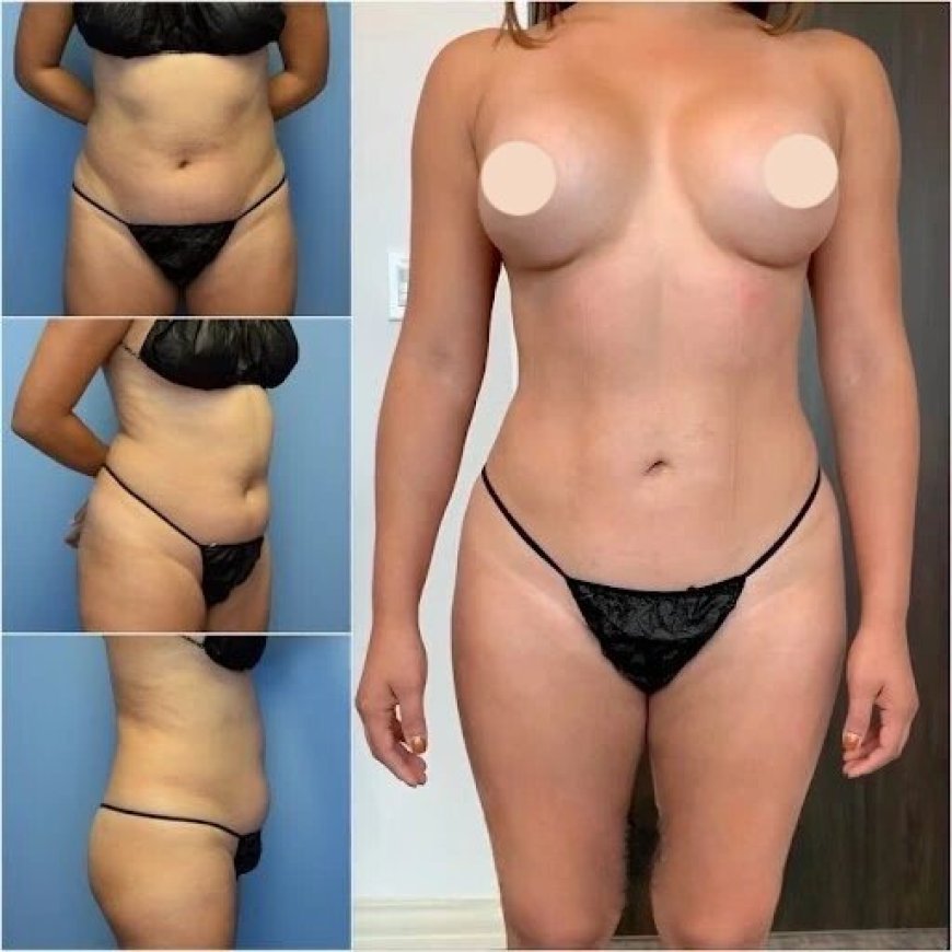 Get the Perfect Body Shape with Body Contouring in Dubai