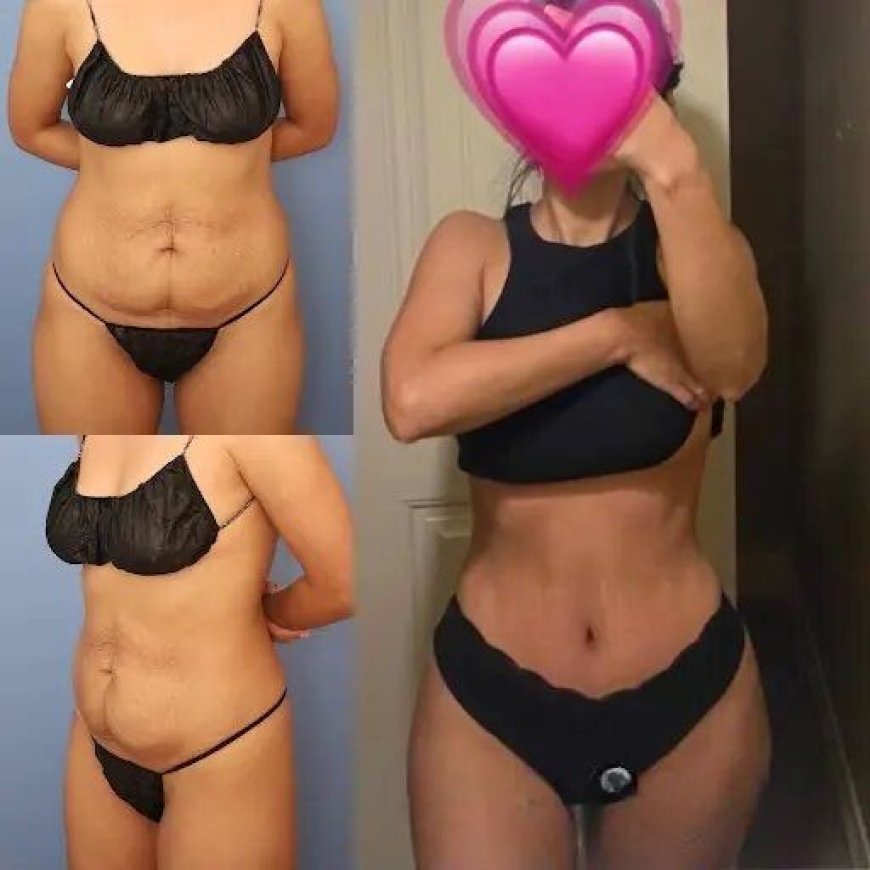 Tummy Tuck in Dubai: Expert Doctors Who Deliver Amazing Results
