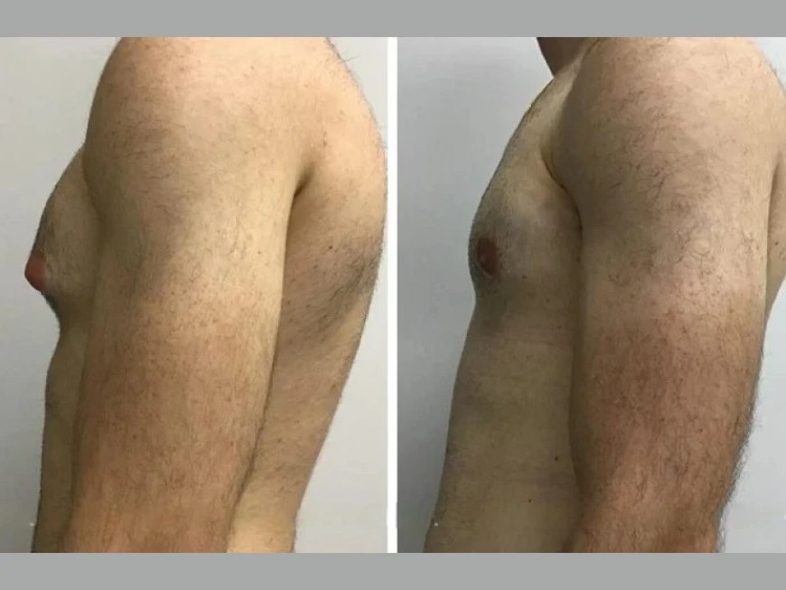 Real Patient Stories of Overcoming Gynecomastia in Dubai