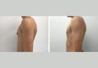 The Truth About Gynecomastia Surgery in Dubai: Choosing the Best Surgeon for Long-Lasting Results