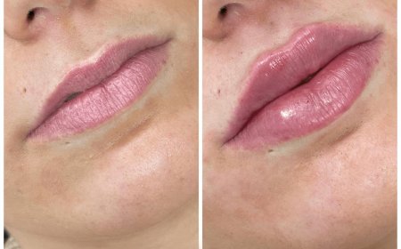 Juvederm for Non-Surgical Facelifts: How the Best Plastic Surgeon in Dubai Can Help