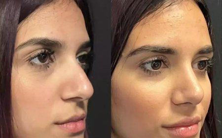 Affordable Yet Best Rhinoplasty Surgeon in Dubai