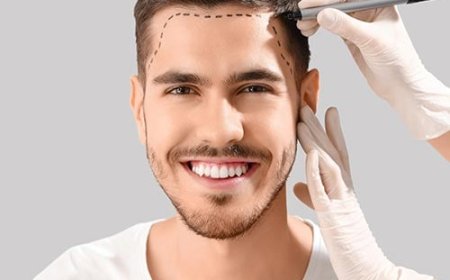 The Complete Guide to Hair Transplant in Dubai