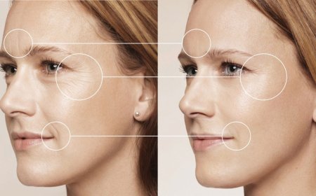 Restore Youthful Volume with Radiesse Treatment in Plano, Texas