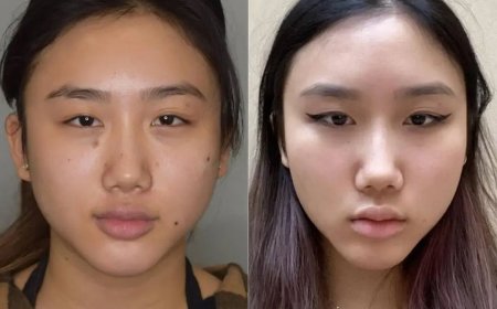 Buccal Fat Removal in Dubai: How to Maintain Facial Harmony