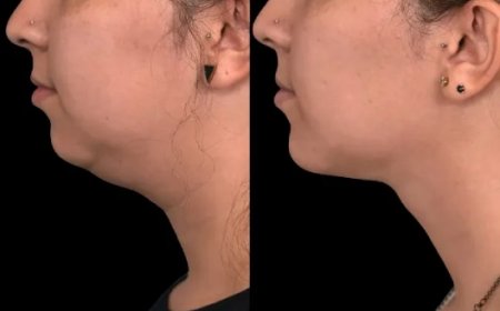 Exploring the Latest Injectable Options for Double chin removal in Dubai