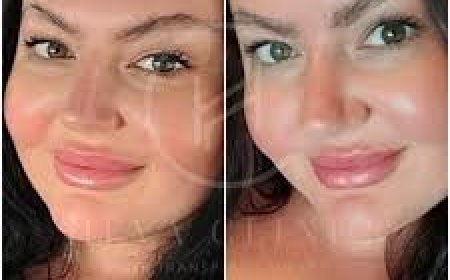 Eyebrow Transplants from the UK to Turkey: Cost-effective Substitutes for London Clinics