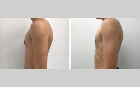 The Truth About Gynecomastia Surgery in Dubai: Choosing the Best Surgeon for Long-Lasting Results