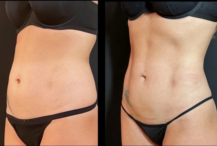 The Science Behind Fat Transfer Surgery in Dubai: How It Works and Why It’s Safe