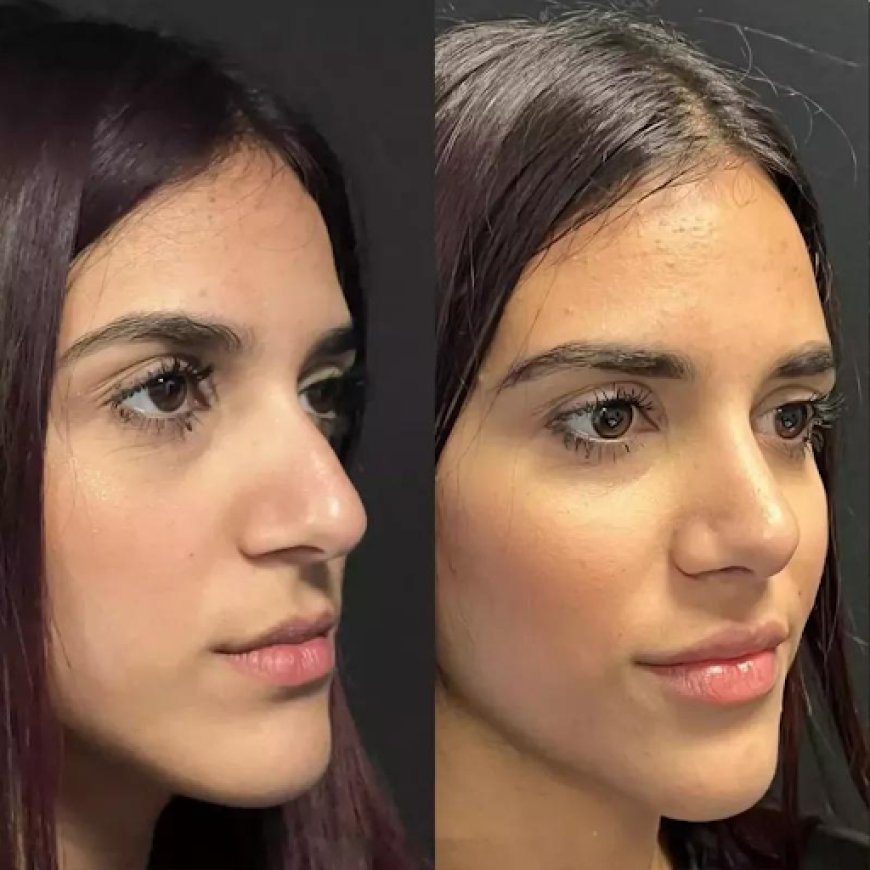 Affordable Yet Best Rhinoplasty Surgeon in Dubai