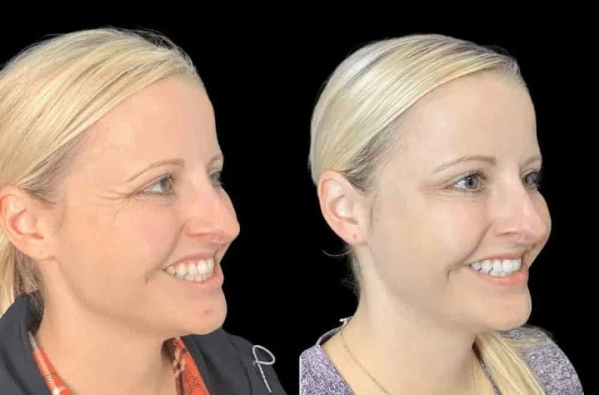 Confidence Restored by the Best Plastic Surgeon in Dubai for Botox