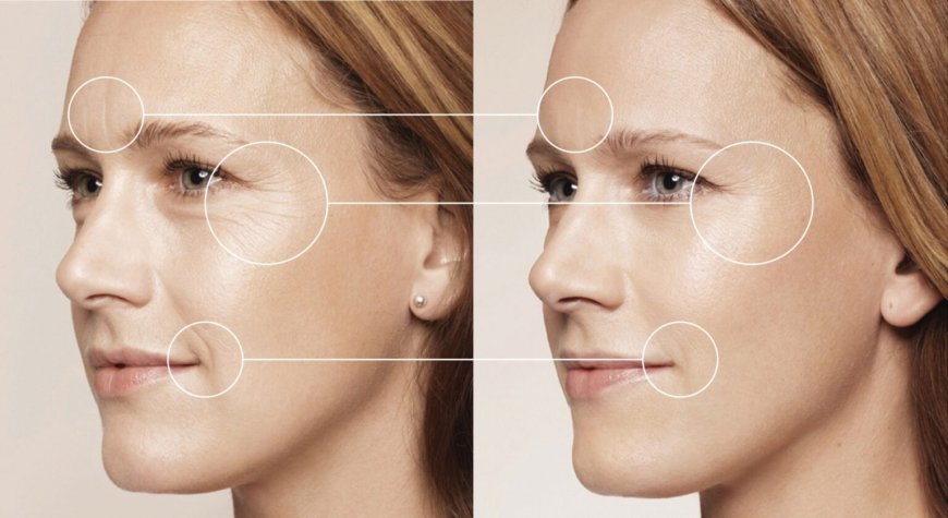 Restore Youthful Volume with Radiesse Treatment in Plano, Texas