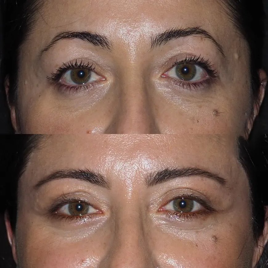 Why men are choosing Eye bag removal in Dubai more often
