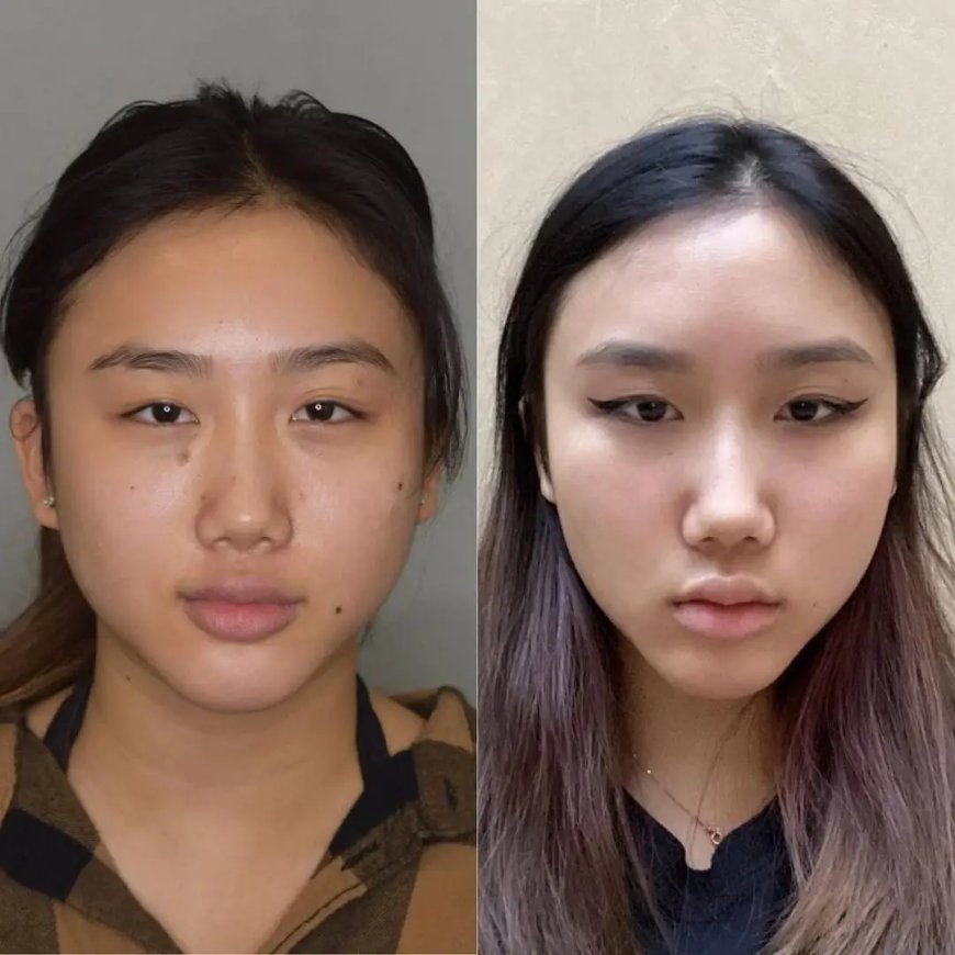 Buccal Fat Removal in Dubai: How to Maintain Facial Harmony