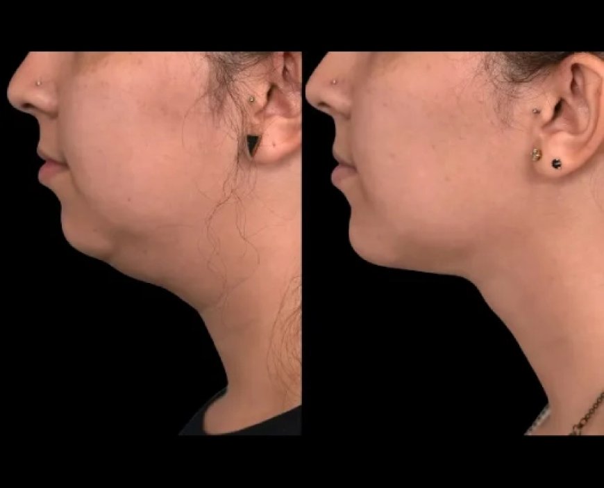 Exploring the Latest Injectable Options for Double chin removal in Dubai