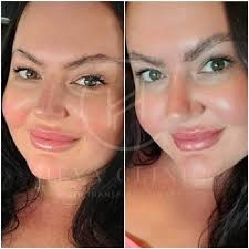 Eyebrow Transplants from the UK to Turkey: Cost-effective Substitutes for London Clinics