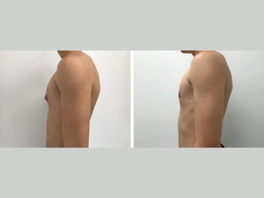 The Truth About Gynecomastia Surgery in Dubai: Choosing the Best Surgeon for Long-Lasting Results